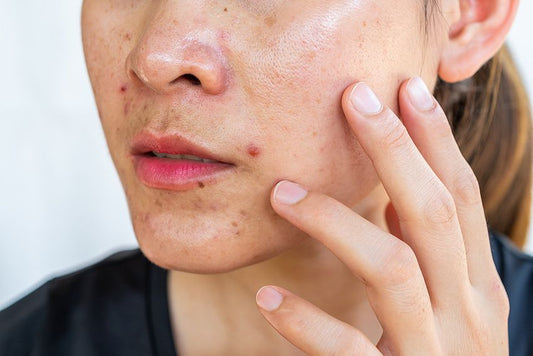 Does Zinc Help Acne?